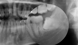 EchoVerse - Author Template 5 impaktirani umnjaci, operacija umnjaka