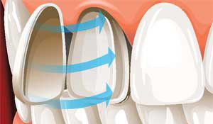 cosmetic-dentistry-porcelain-veneers