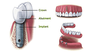 dental-implant-procedure