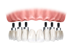 dental_implant_upper_arch